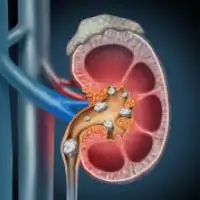 photo of kidney stones
