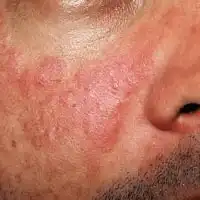 photo of lupus rash