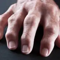 photo of rheumatoid arthritis in hand