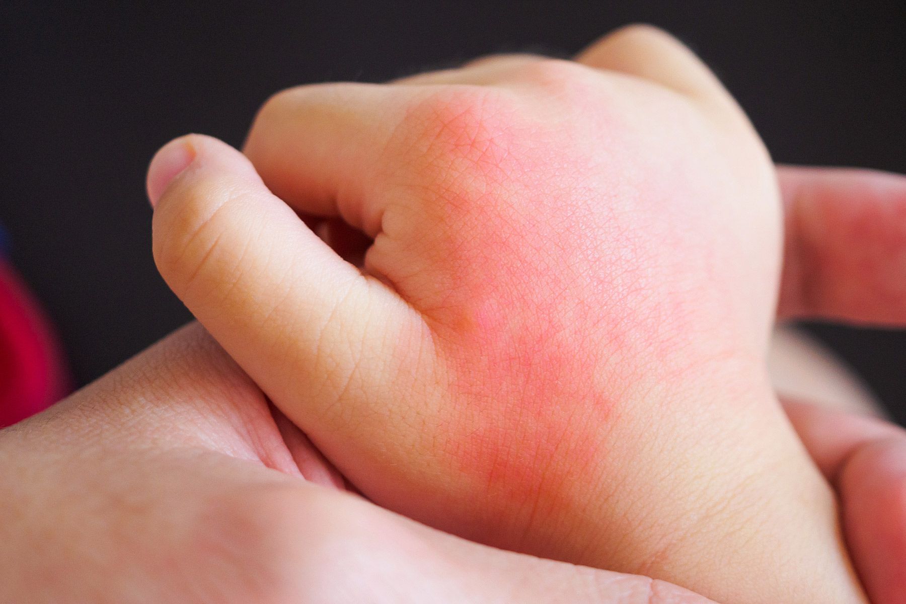 Preventing Eczema in Babies With Dry Skin