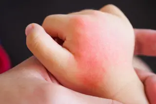 eczema on baby hand