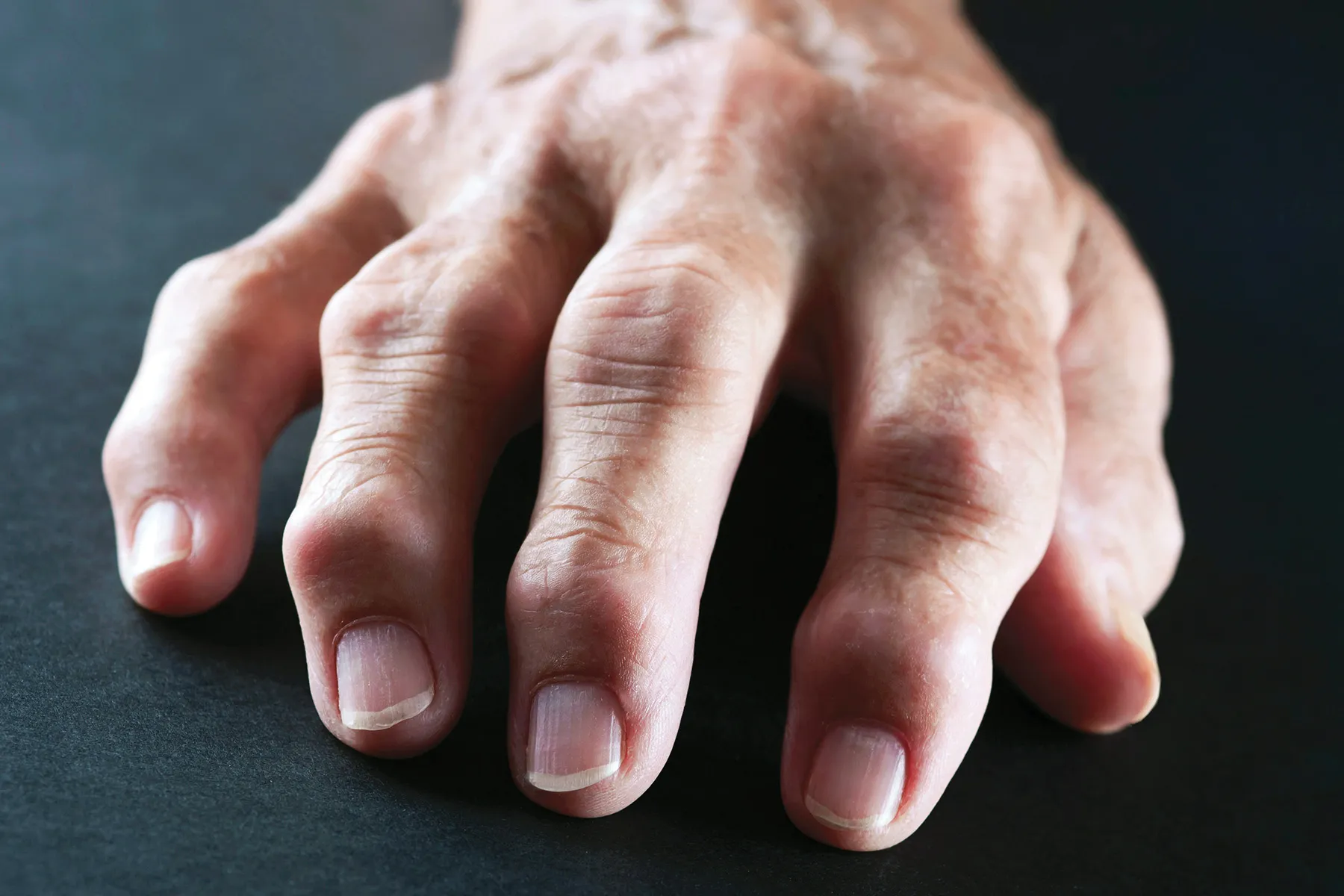 photo of hand displaying rheumatoid arthritis