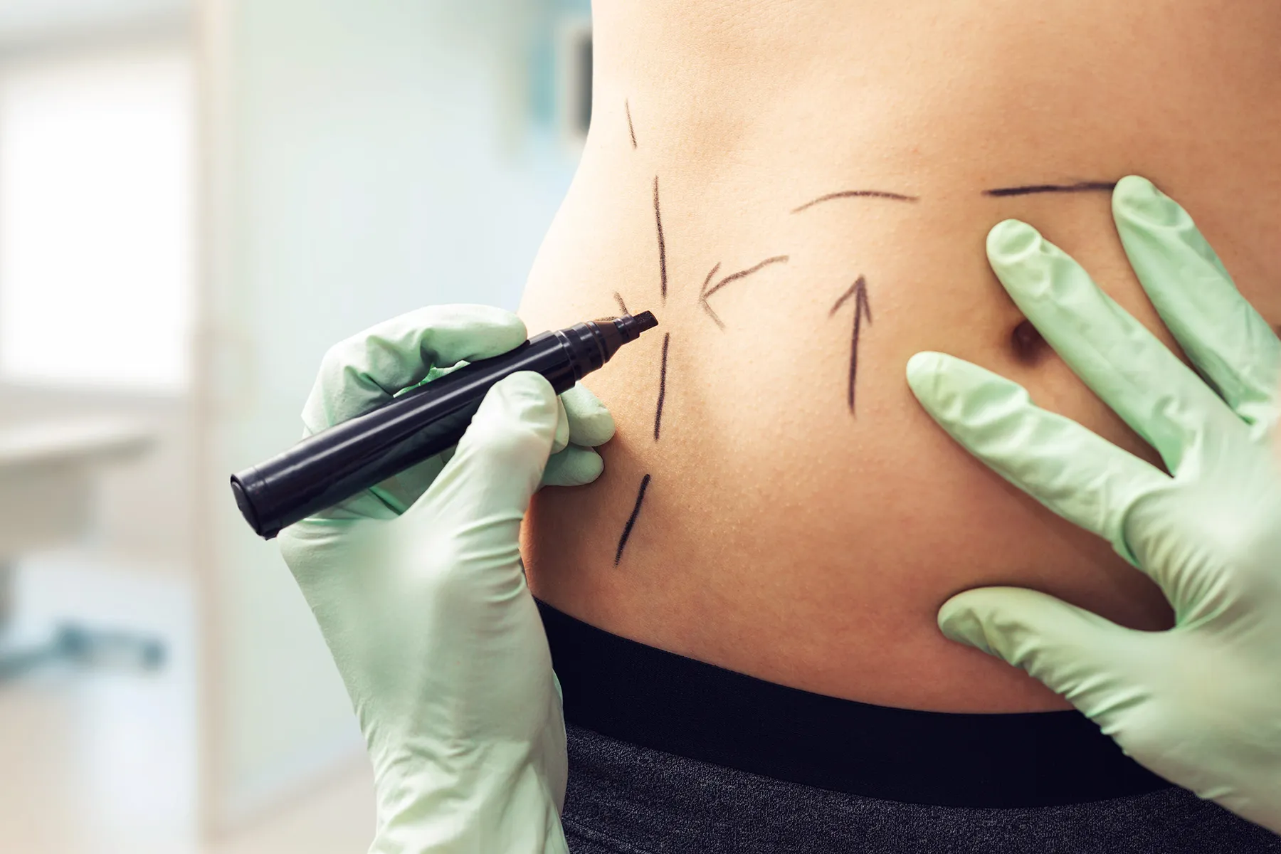 Liposuction: How It Works, Types, Safety, Side Effect & Benefits