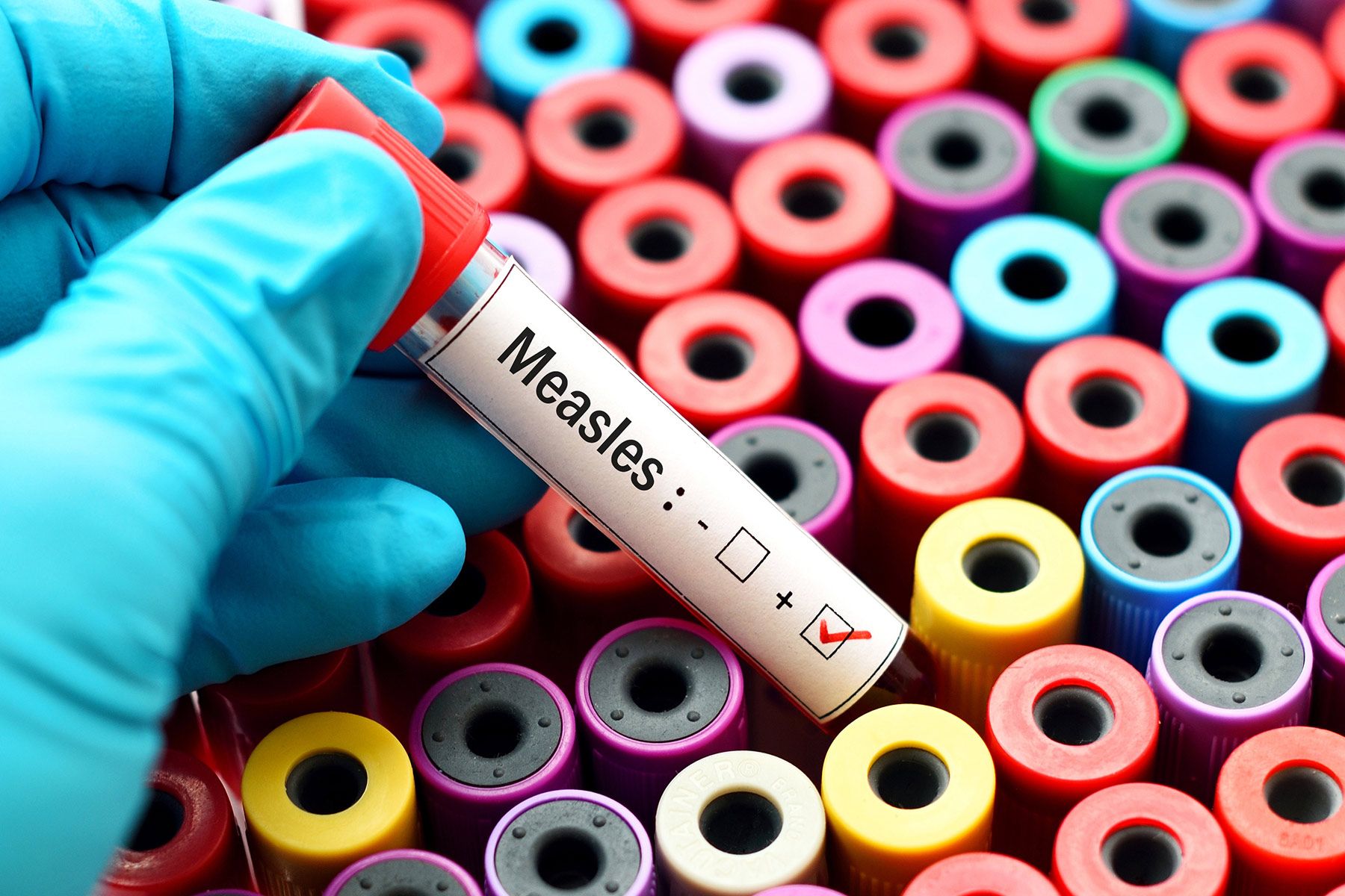 WHO, UNICEF Warn About Increased Risk of Measles Outbreaks