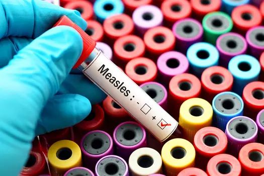 measles testing concept