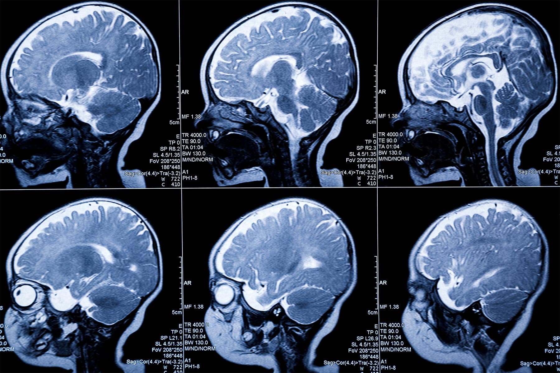 New MRI Technique Might Help Spot MS Sooner