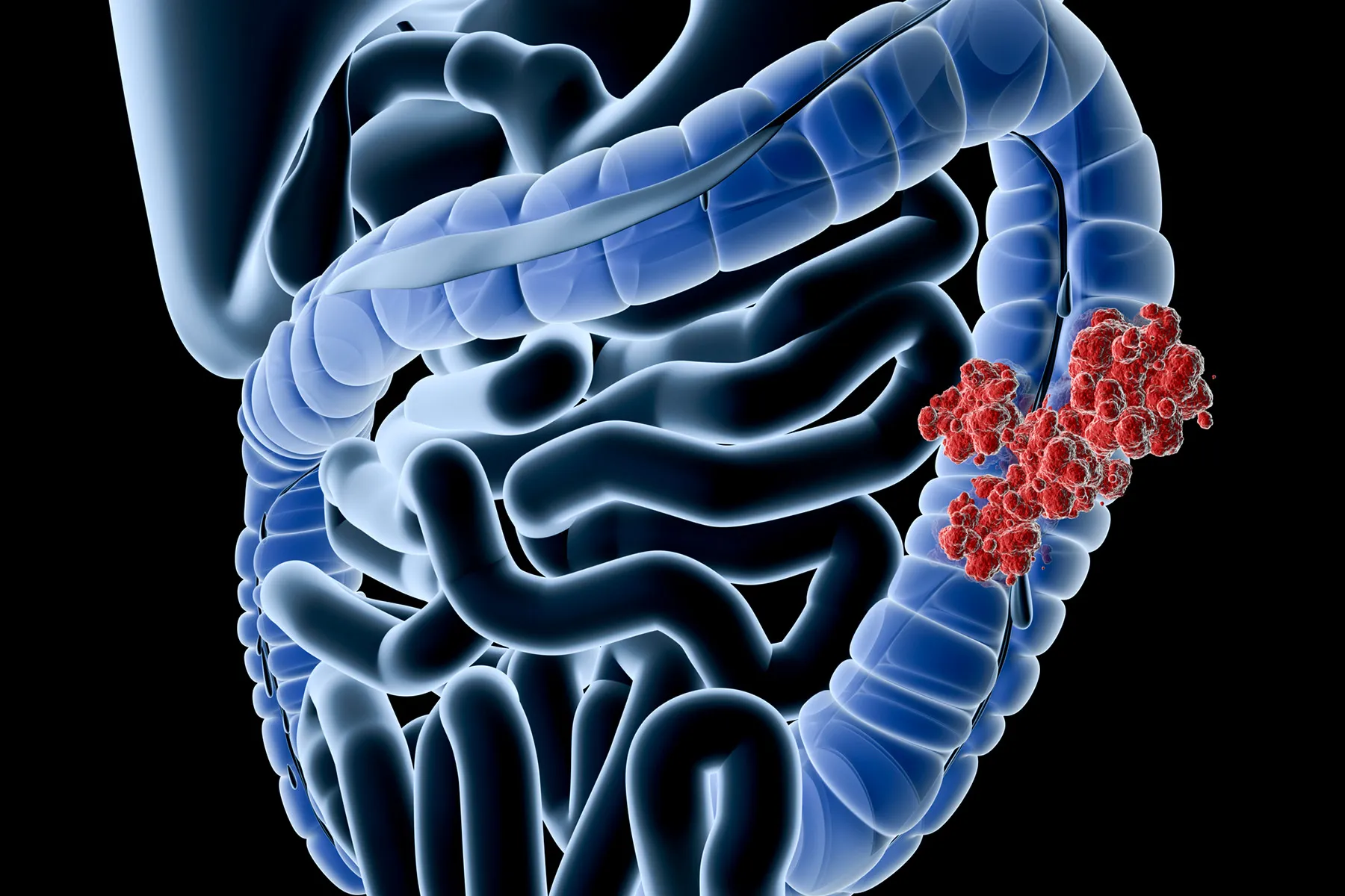 Early Onset Colorectal Cancer: Why Is This Happening?