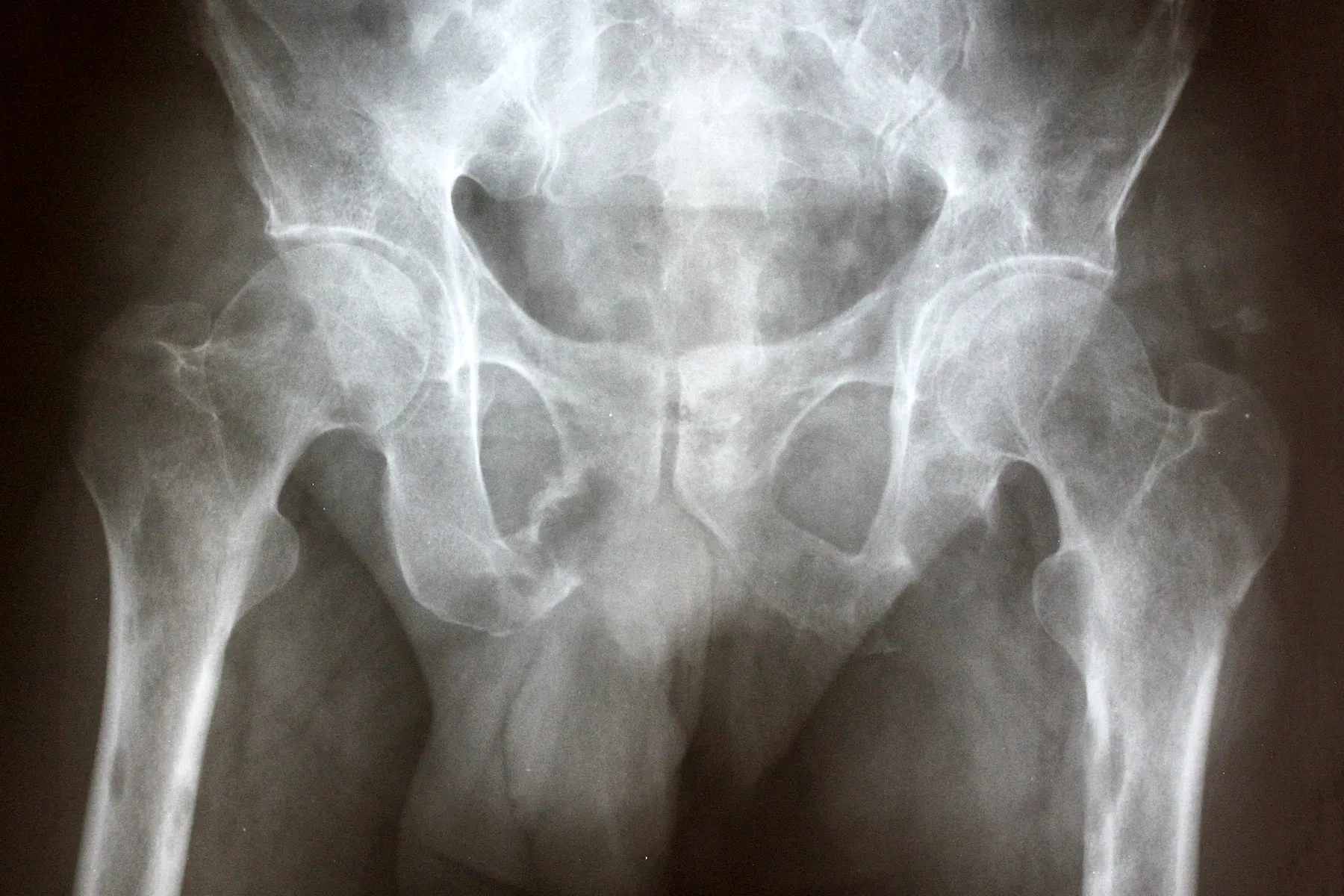 ovarian cancer x ray)