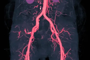 photo of peripheral angiography