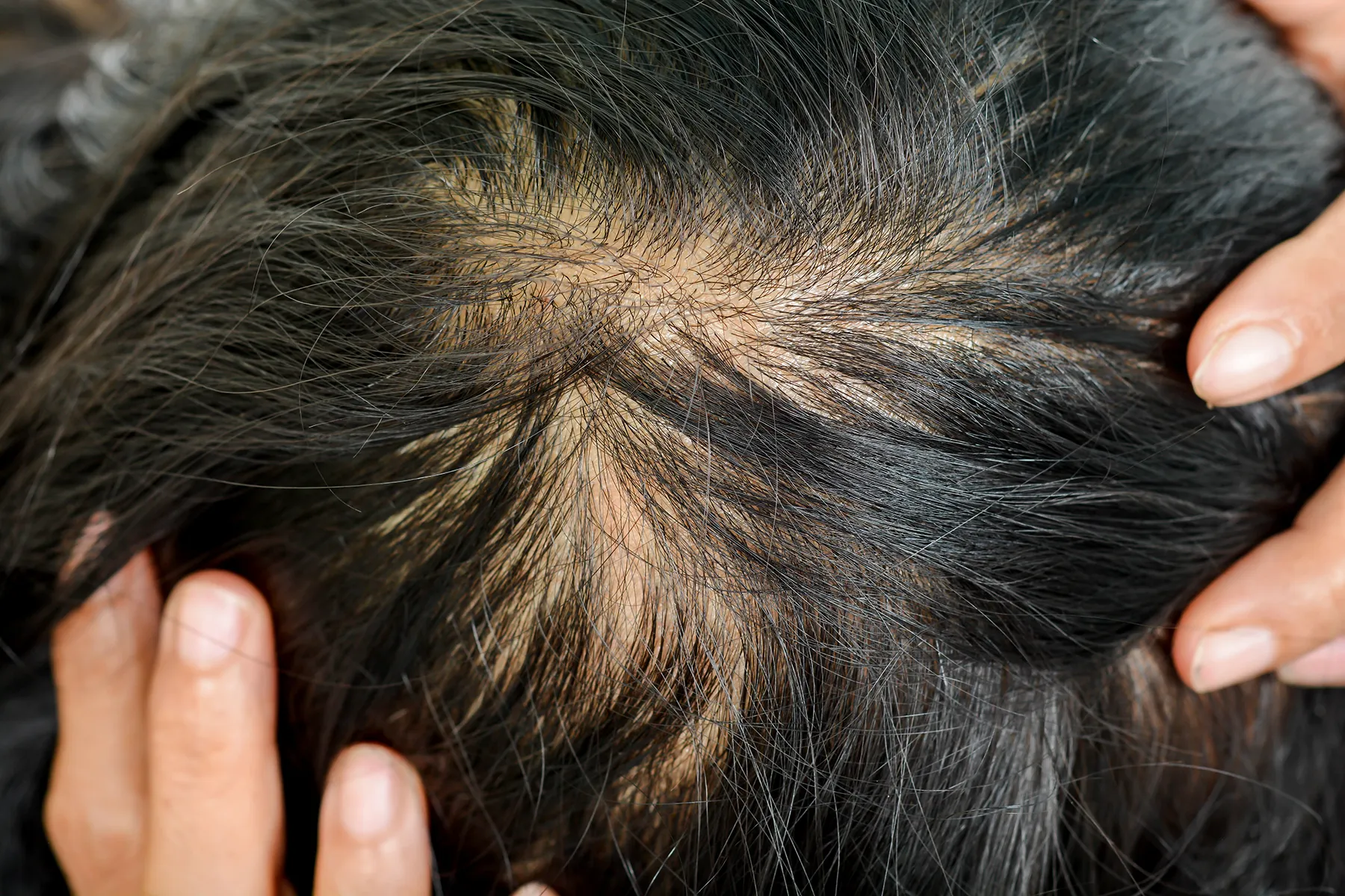Bald Truth: Mouse Study May Get at Roots of Hair Loss thumbnail
