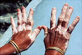 vitiligo on hands