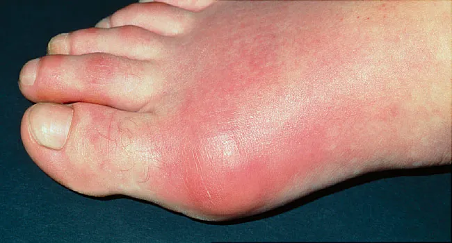 toe joint inflamed with gout