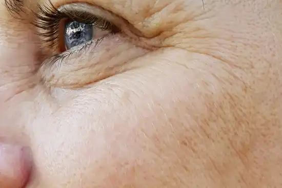 photo of wrinkles