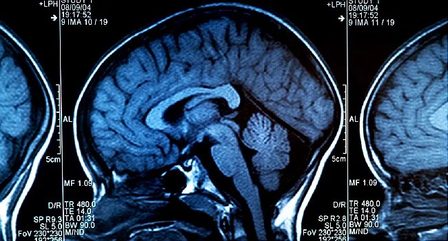 MRI Scan of human brain