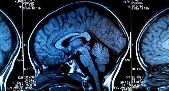 MRI Scan of human brain