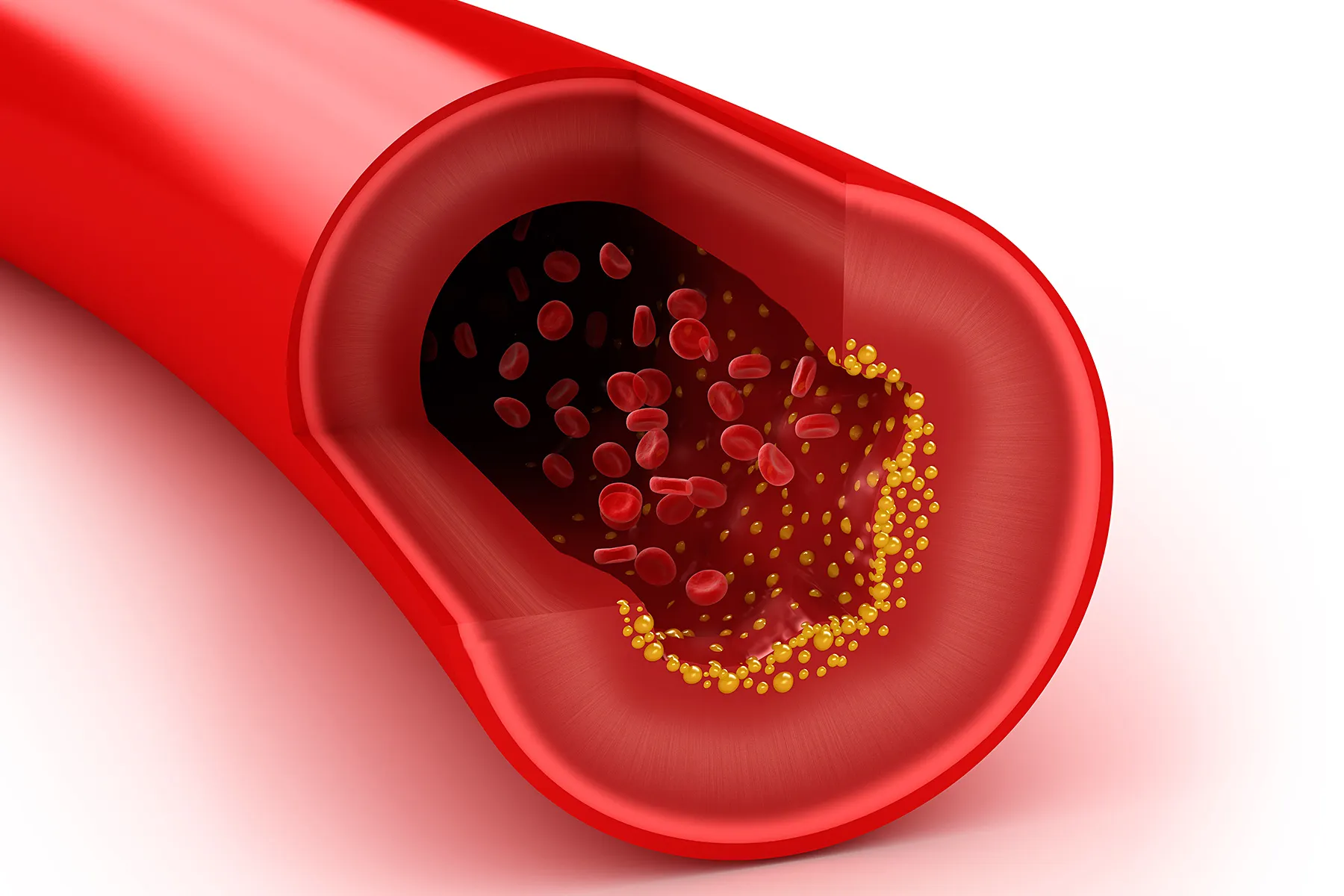 cholesterol plaque in artery wall