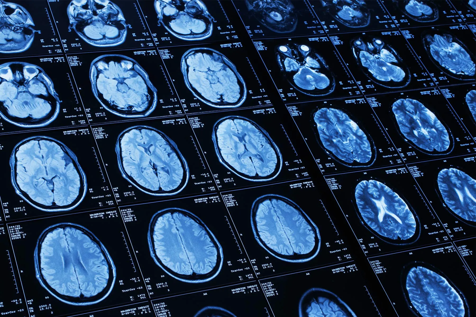 photo of brain scan of stroke