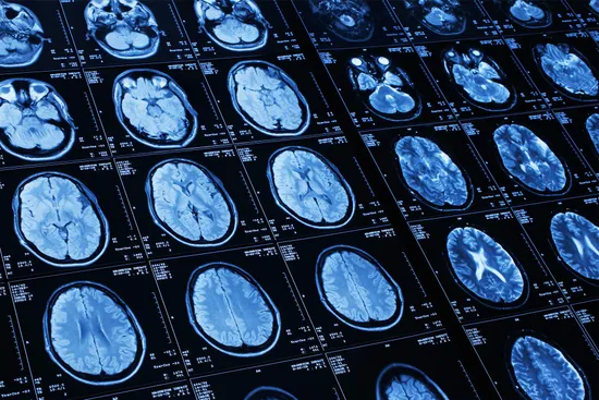 photo of brain scan of strokephoto of brain scan of stroke
