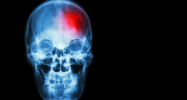 brain scan of stroke