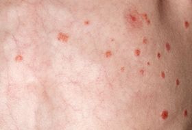 guttate psoriasis signs of pregnancy