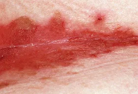 does psoriasis burn and itch vörös foltok a kézen lymphostasis fotóval