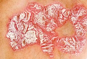 plaque psoriasis what does it look like