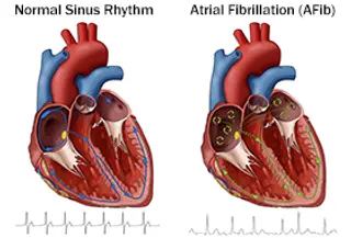AFib and normal sinus rhythm