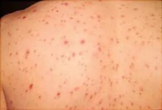 person with chickenpox on back