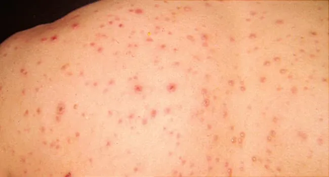 person with chickenpox on back