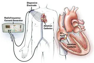 catheter ablation