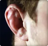 Cauliflower Ear Symptoms Causes And Treatments