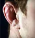 Cauliflower Ear: Symptoms, Causes, and Treatments