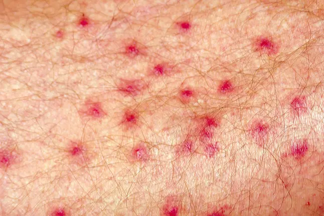 photo of Cercarial dermatitis: Swimmer's itch