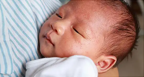 newborn with rash on face