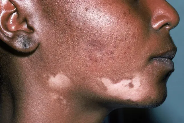 photo of depigmented patch of skin