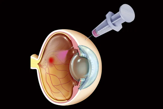 macular edema surgery recovery time