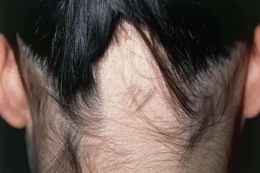 photo of alopecia areata at  back of woman's head