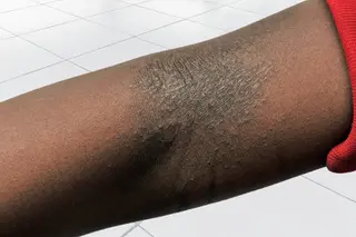 photo of eczema on arm