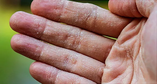 atopic dermatitis causes a szemöldök fölött vörös folt viszket