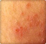 atopic dermatitus