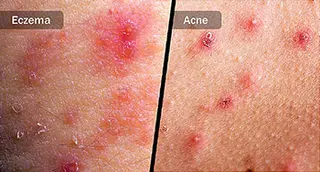 eczema and acne diptych