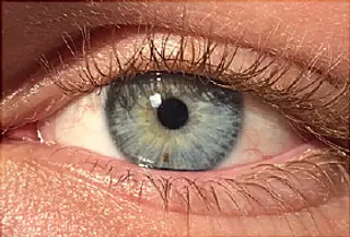 eye freckle