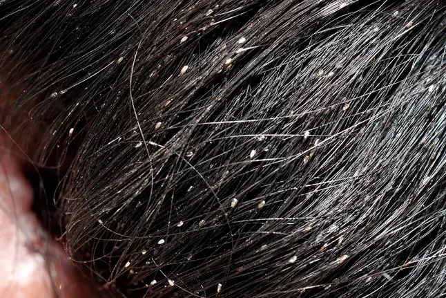 photo of head lice on child's hairs
