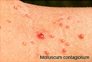 molluscum contagiosum rash