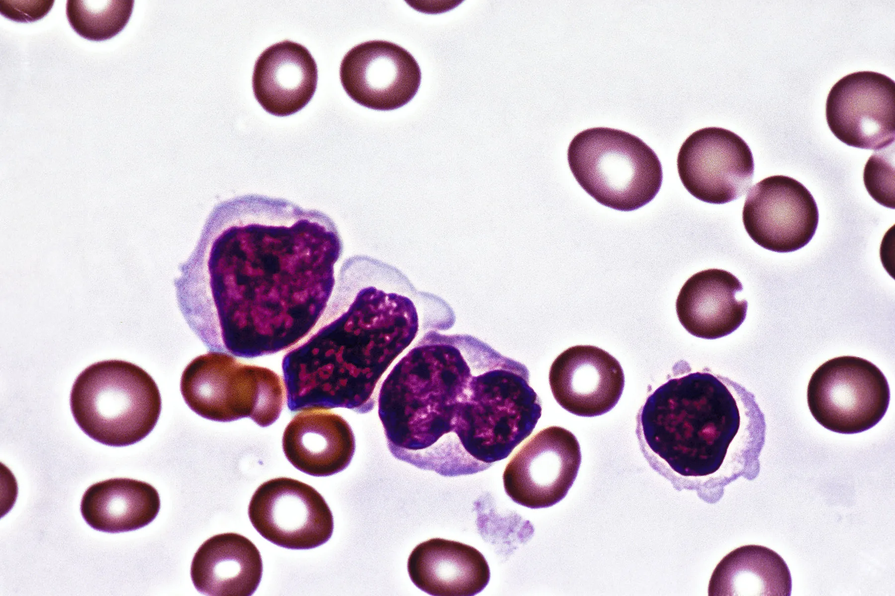 lymphocytic leukemia micrograph