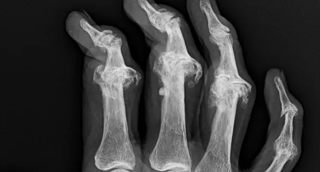 photo of psoriatic arthritis in hand