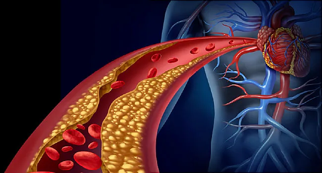 Placa de colesterol impede passagem de sangue