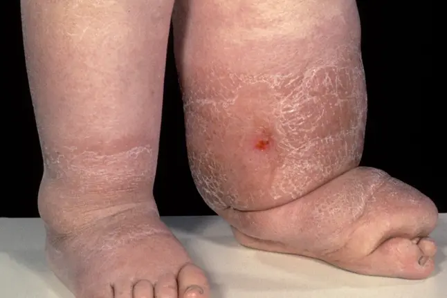 photo of lymphedema in legs