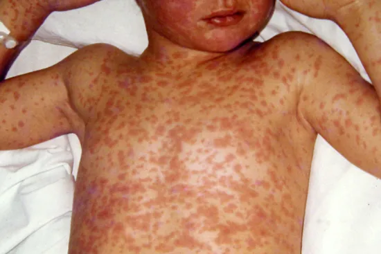 photo of measles on child's torso