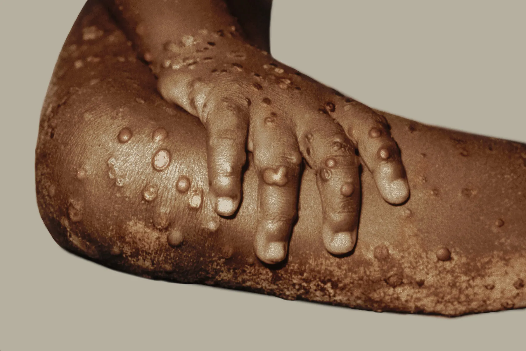 Monkeypox Case Charges 5 Times Increased in Sad American citizens thumbnail